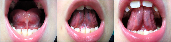 Le anomalie del frenulo linguale - Paziente di otto anni, prima e dopo freneulectomia